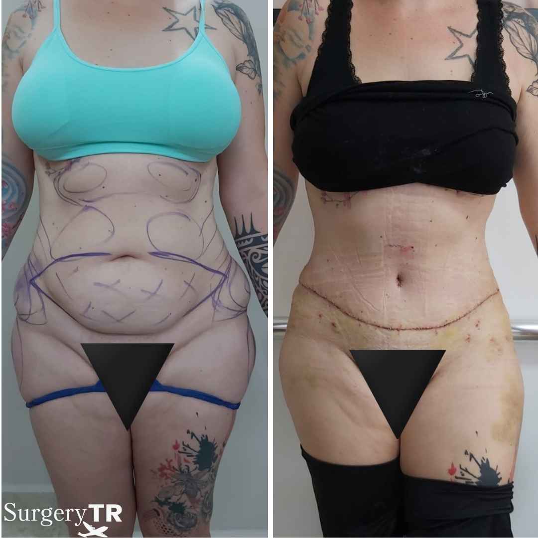TummyTuck BeforeAfter 1 3