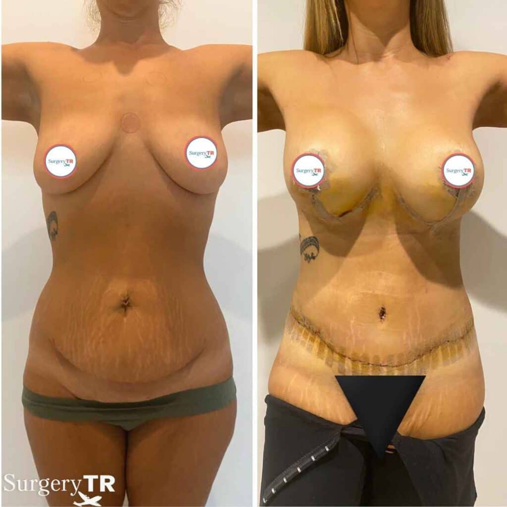 TummyTuck BeforeAfter 1 4