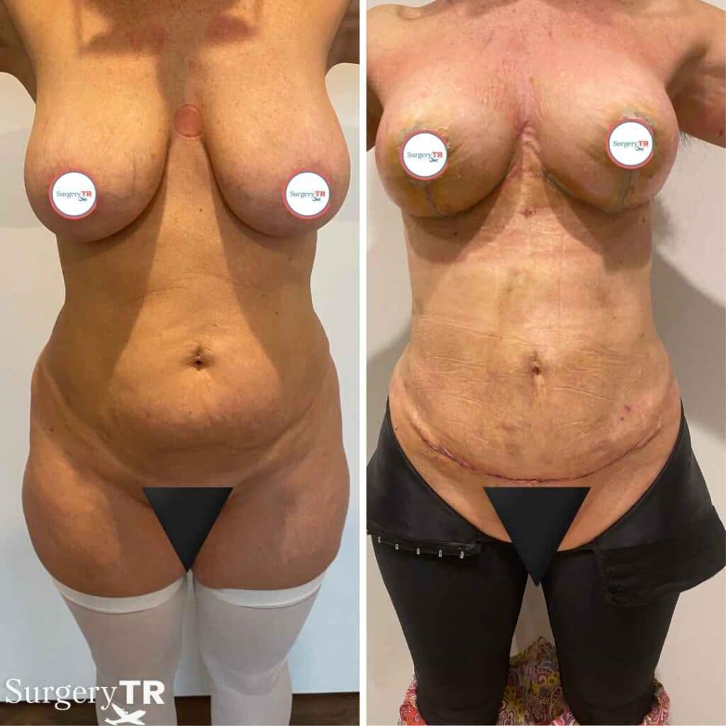 TummyTuck BeforeAfter 1 5