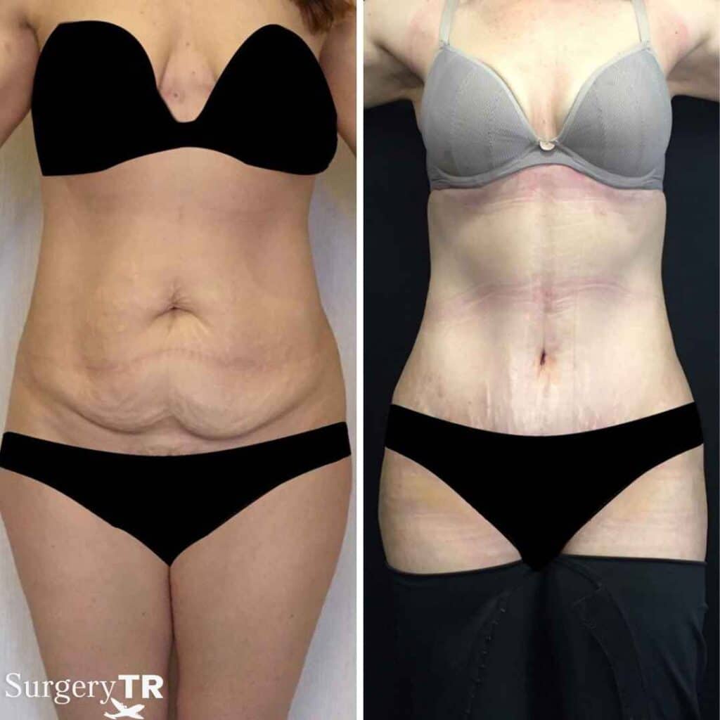 TummyTuck BeforeAfter 1 6