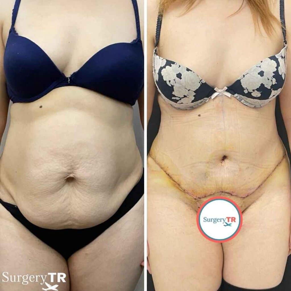 TummyTuck BeforeAfter 1 7