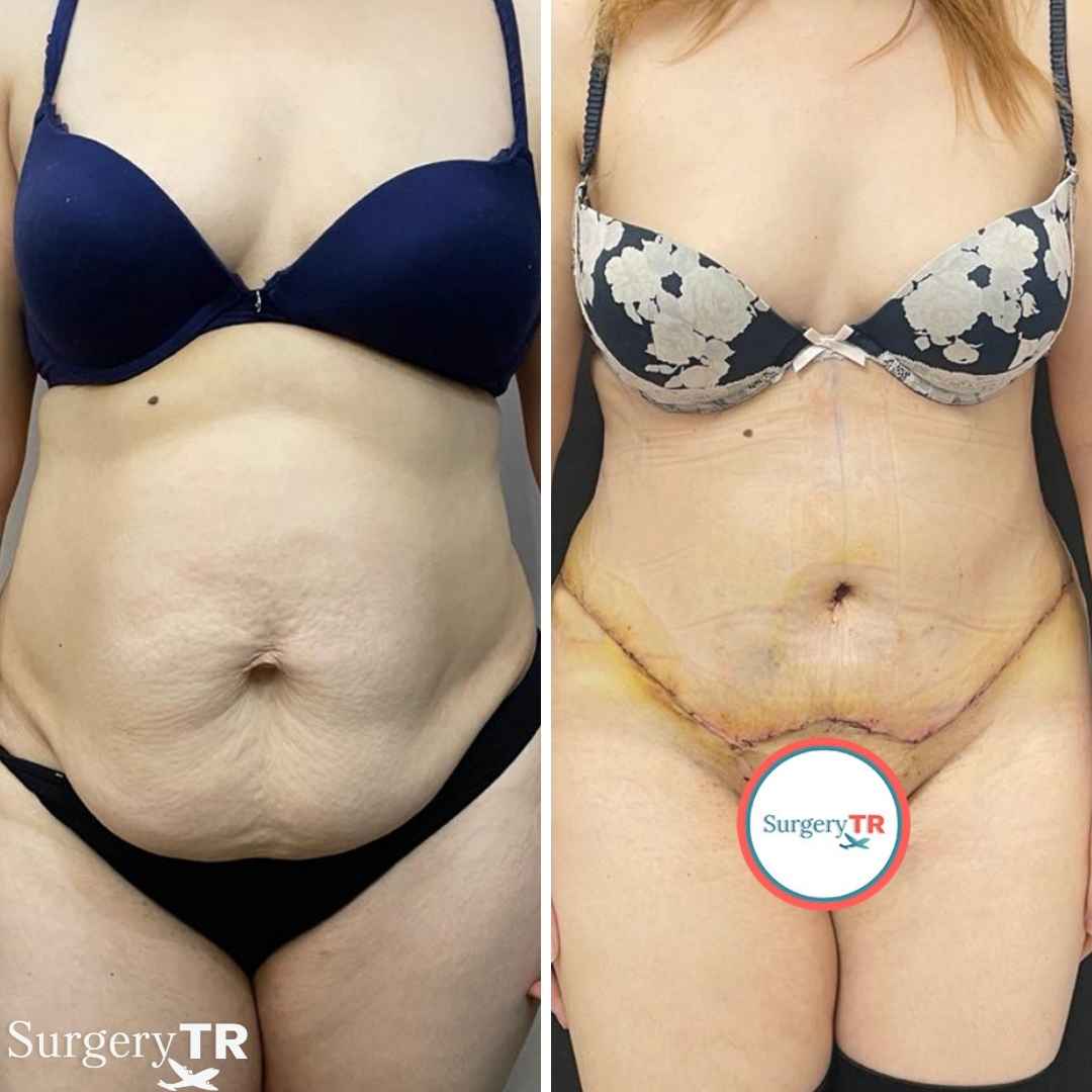 TummyTuck BeforeAfter 1 7