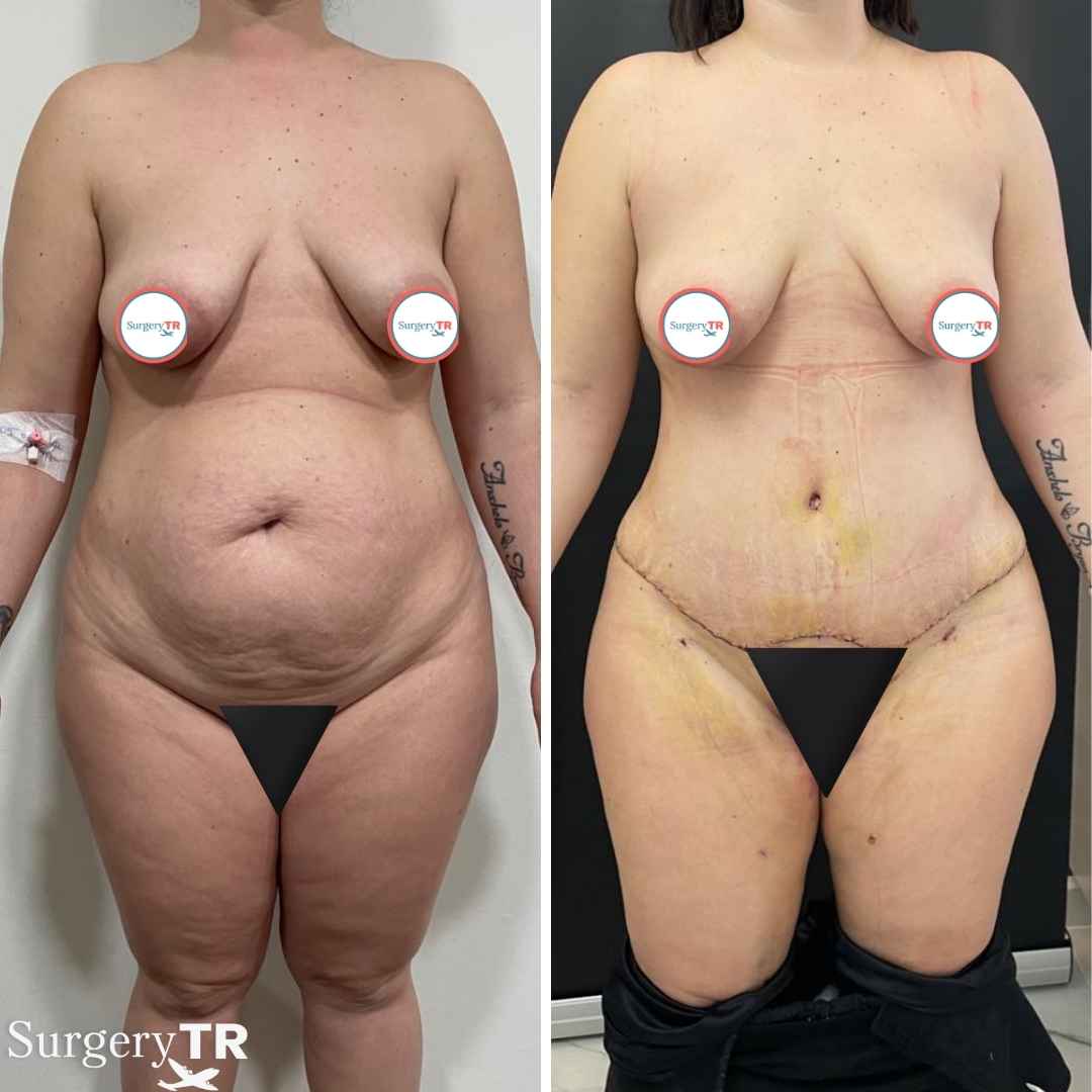 TummyTuck BeforeAfter 1 8
