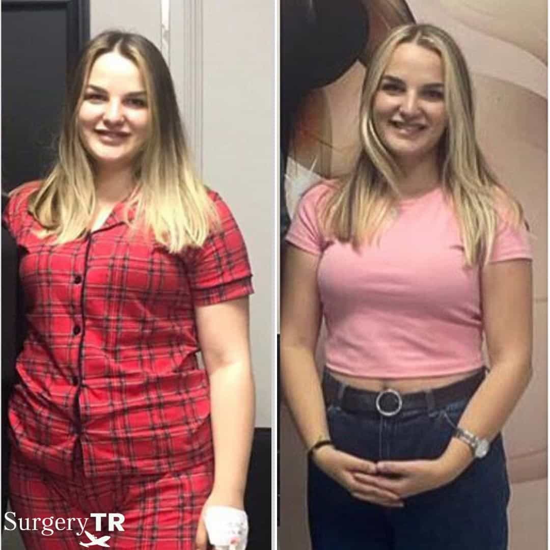 Weight Loss Before After 5