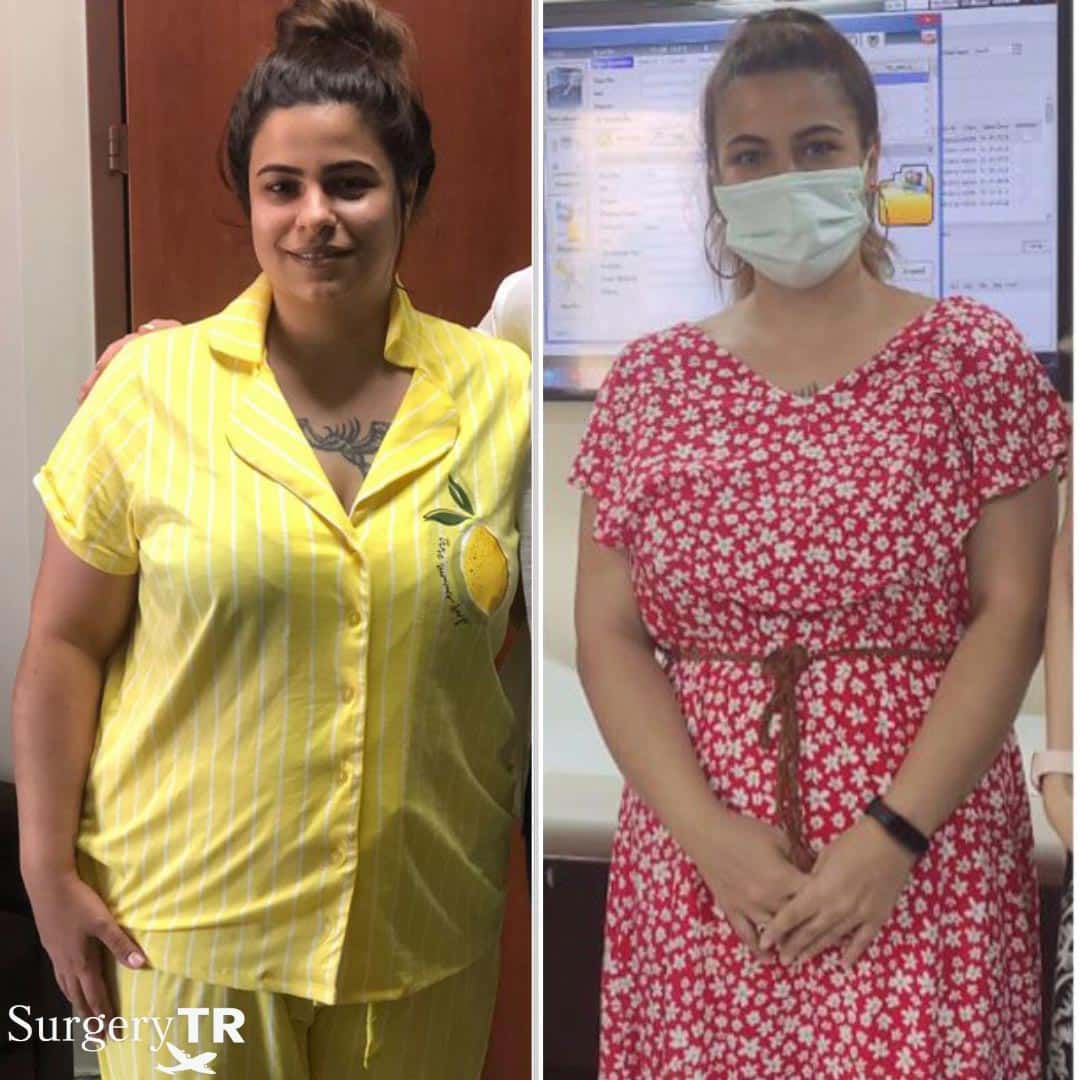Weight Loss Surgery Before / After Gallery SurgeryTR