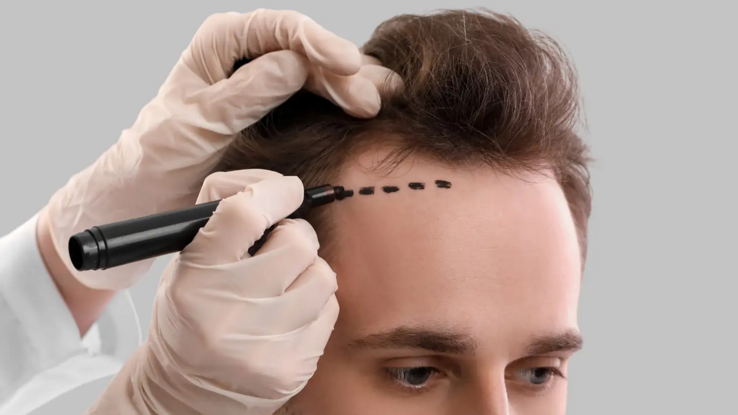 How Much Does a 3000 Grafts Hair Transplant Cost in Turkey?