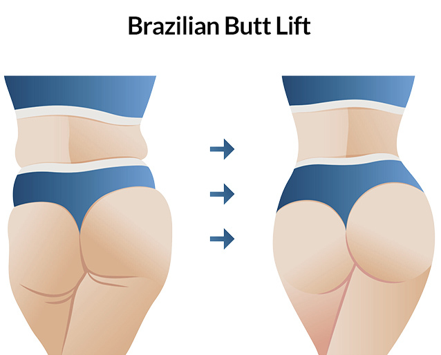 10 Things You Need to Know About Brazilian Butt Lift 1 Brazilian Butt Lift
