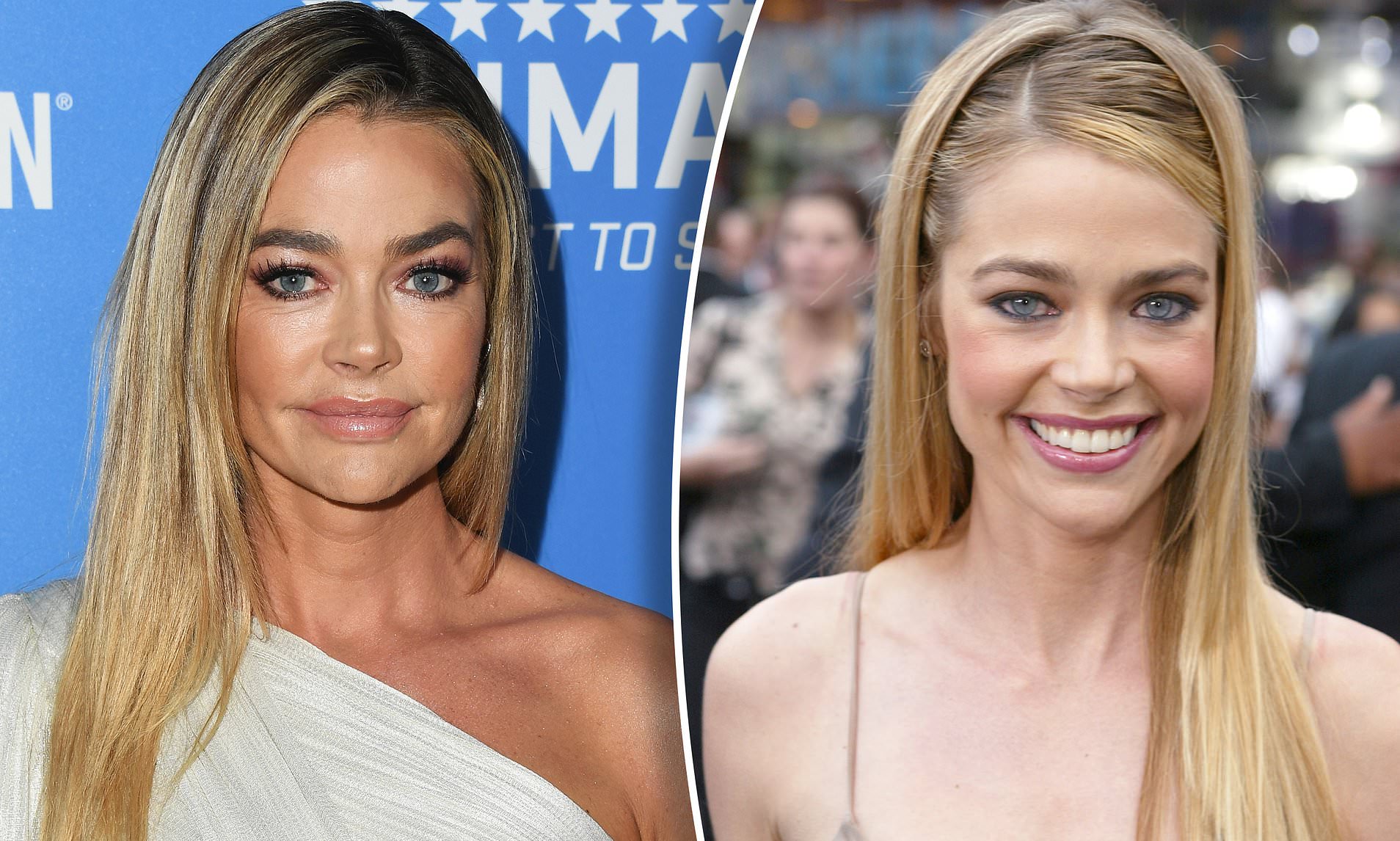 Denise Richards Plastic Surgery - Surgerytr