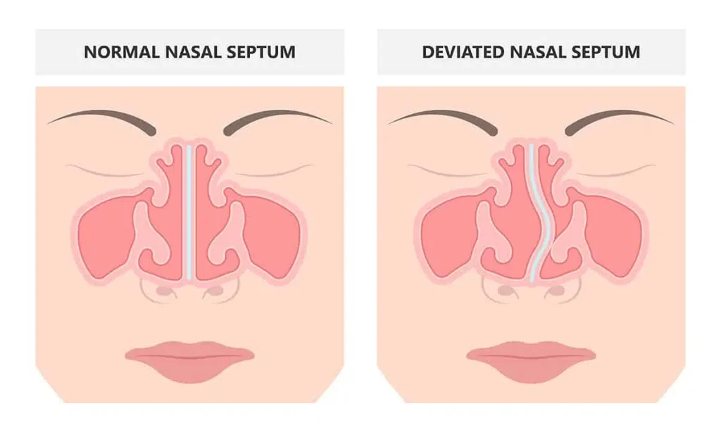 Deviated Nasal Septum