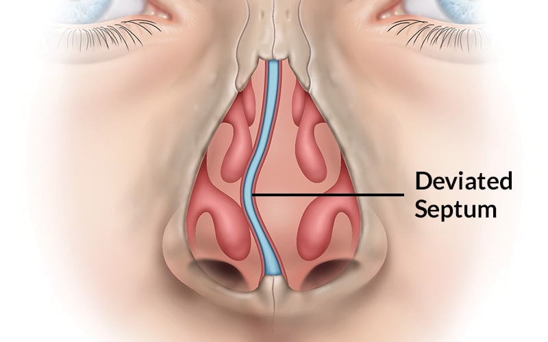 Deviated Septum pic
