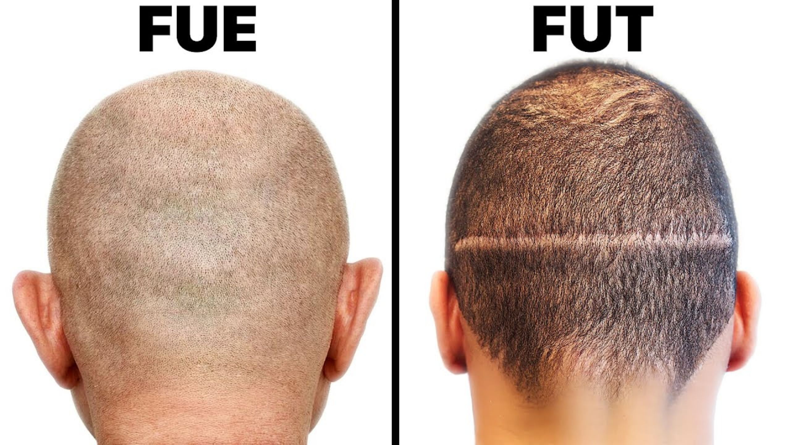 FUE vs. FUT: Which One is Better for Hair Transplantation?