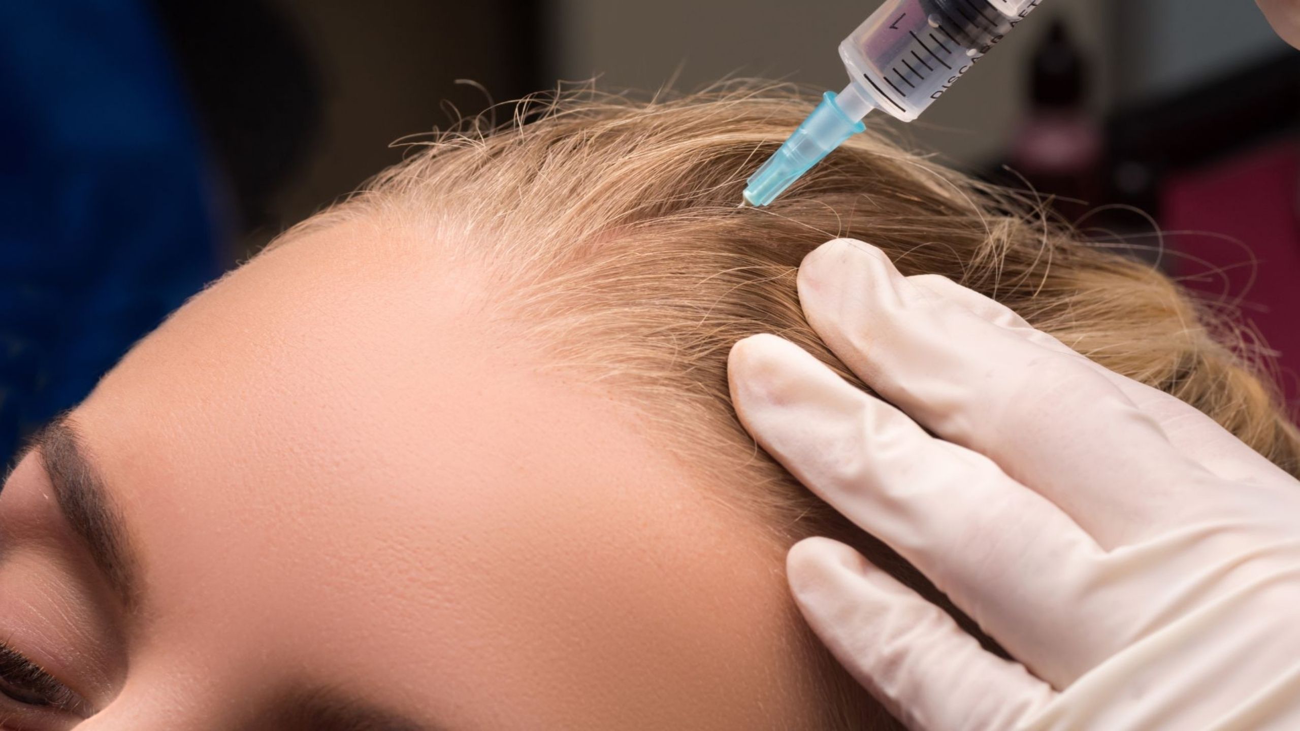 Mesotherapy for Hair: The Great Alternative and Practical Treatment
