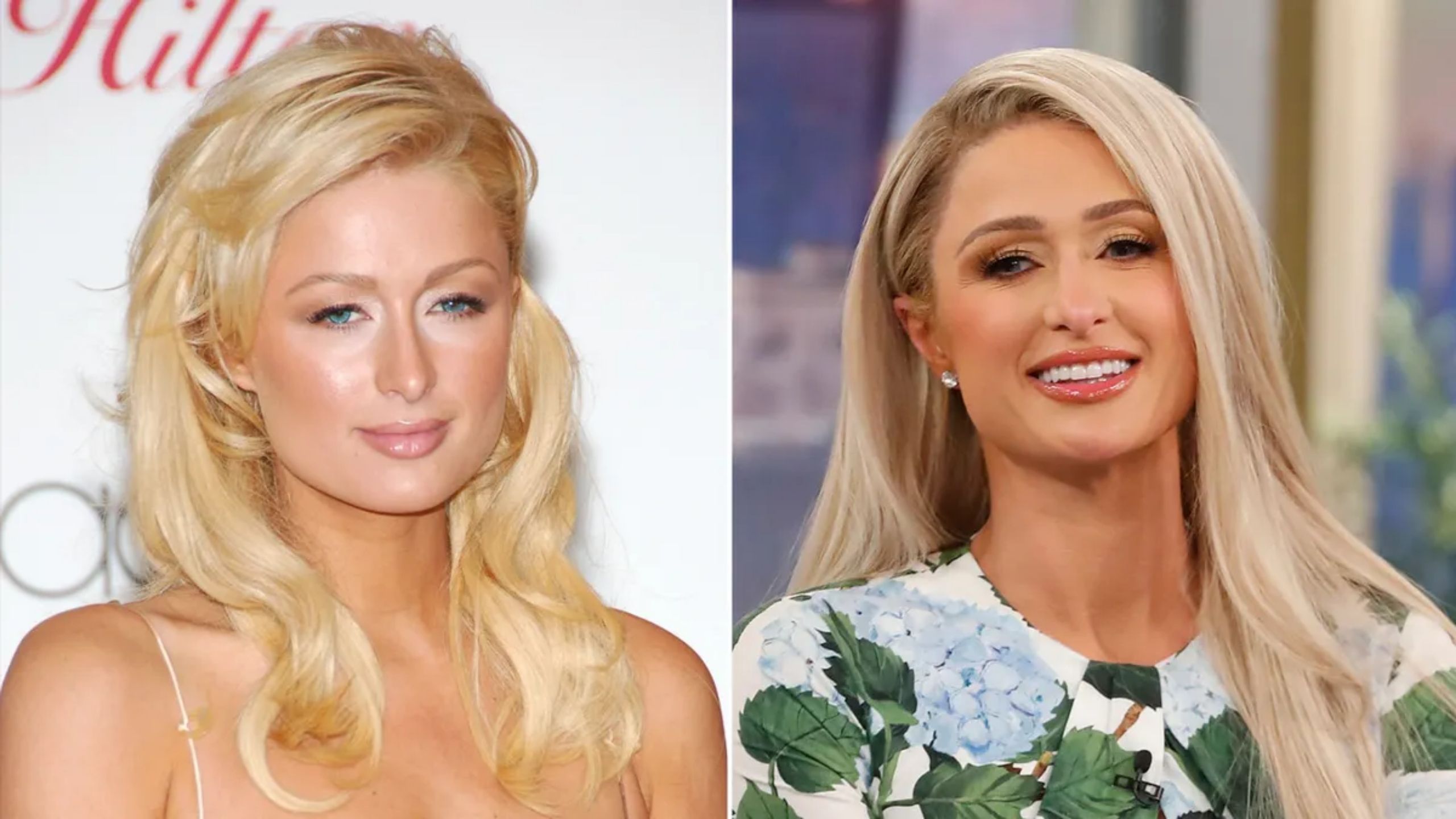 Paris Hilton Plastic Surgery