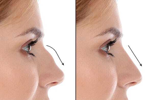 choosing a rhinoplasty surgeon