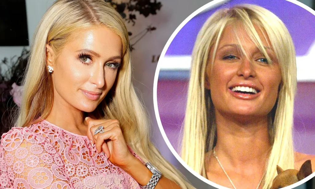 Paris Hilton Plastic Surgery 1 paris hilton before after