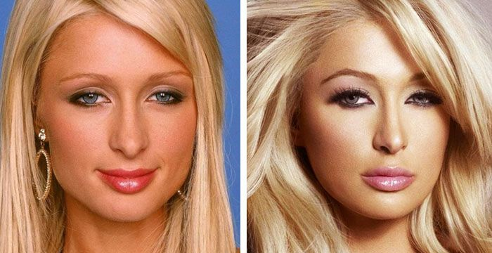 Paris Hilton Plastic Surgery 2 paris hilton