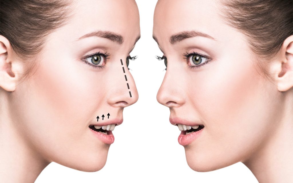 rhinoplasty
