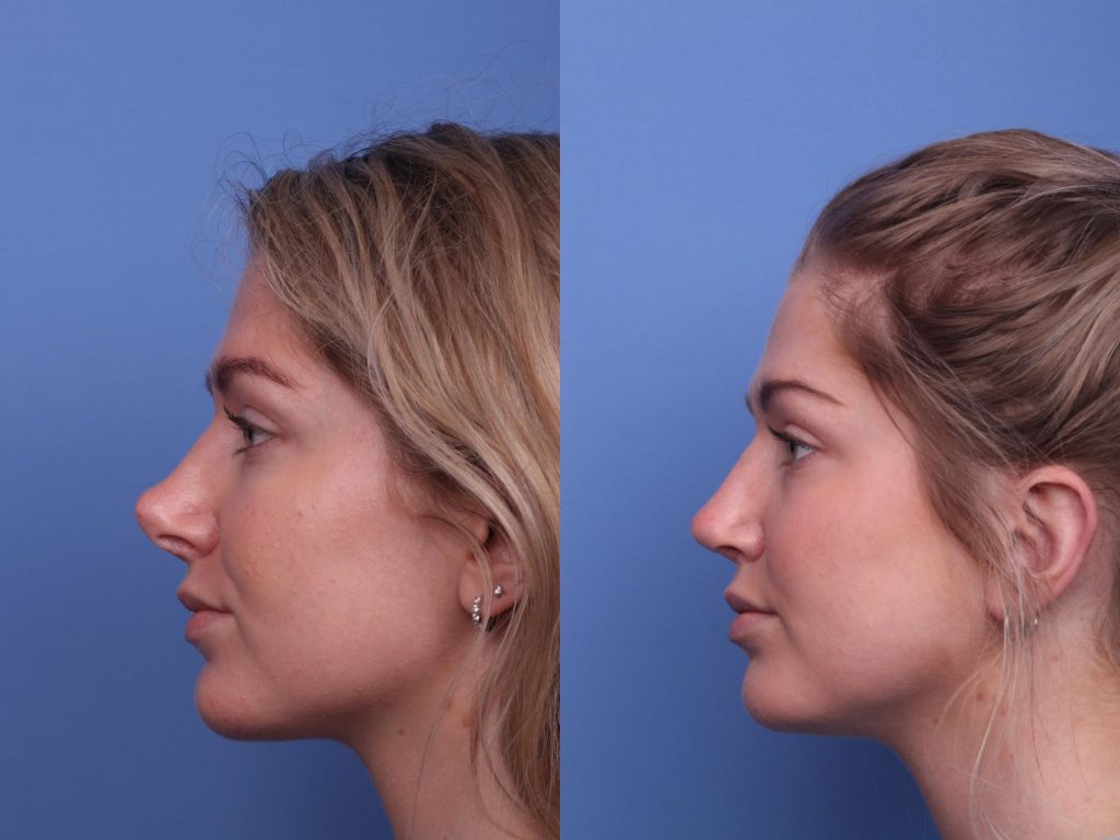 rhinoplasty revision left side detail