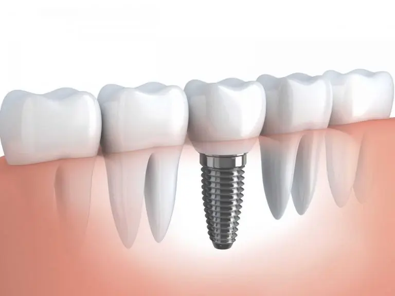 turkey dental implant