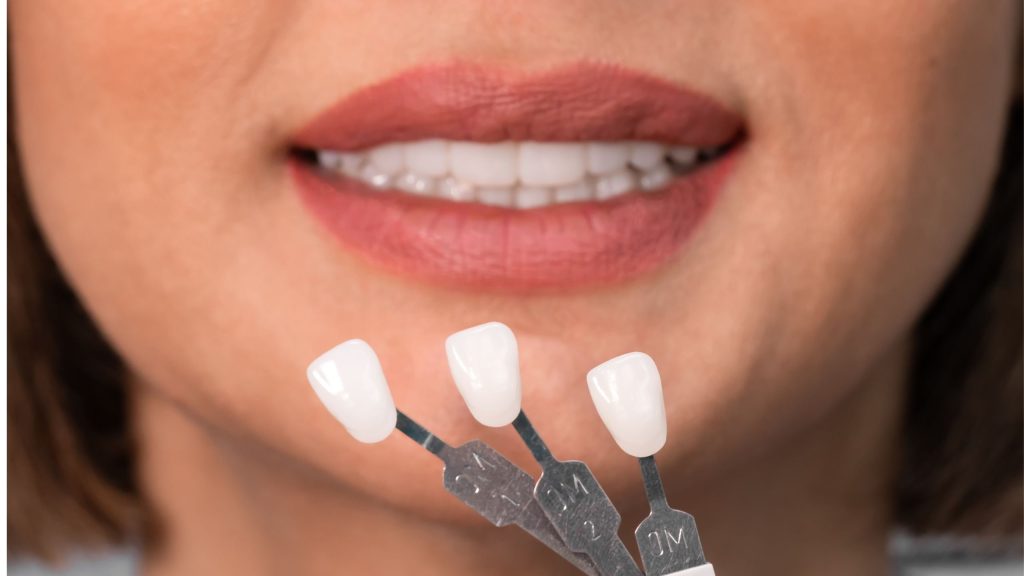 Composite and Porcelain Veneers