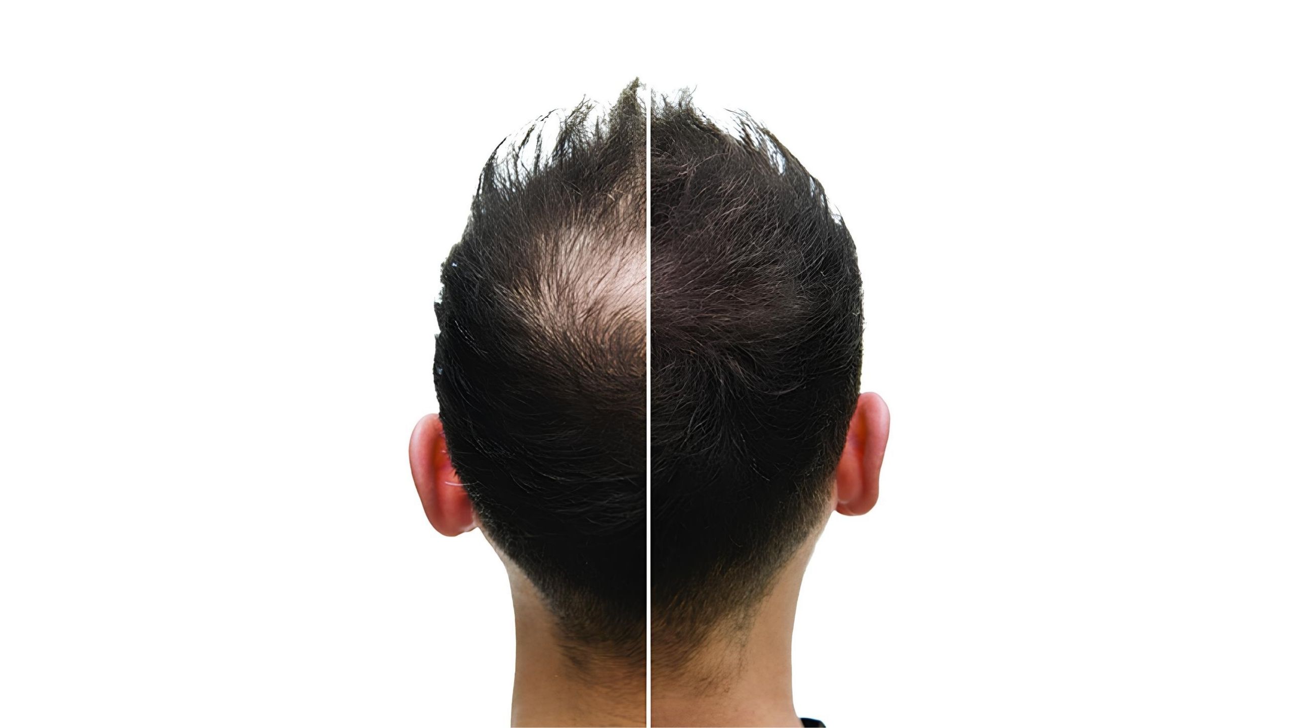 Does PRP Treatment Really Work for Hair Loss?