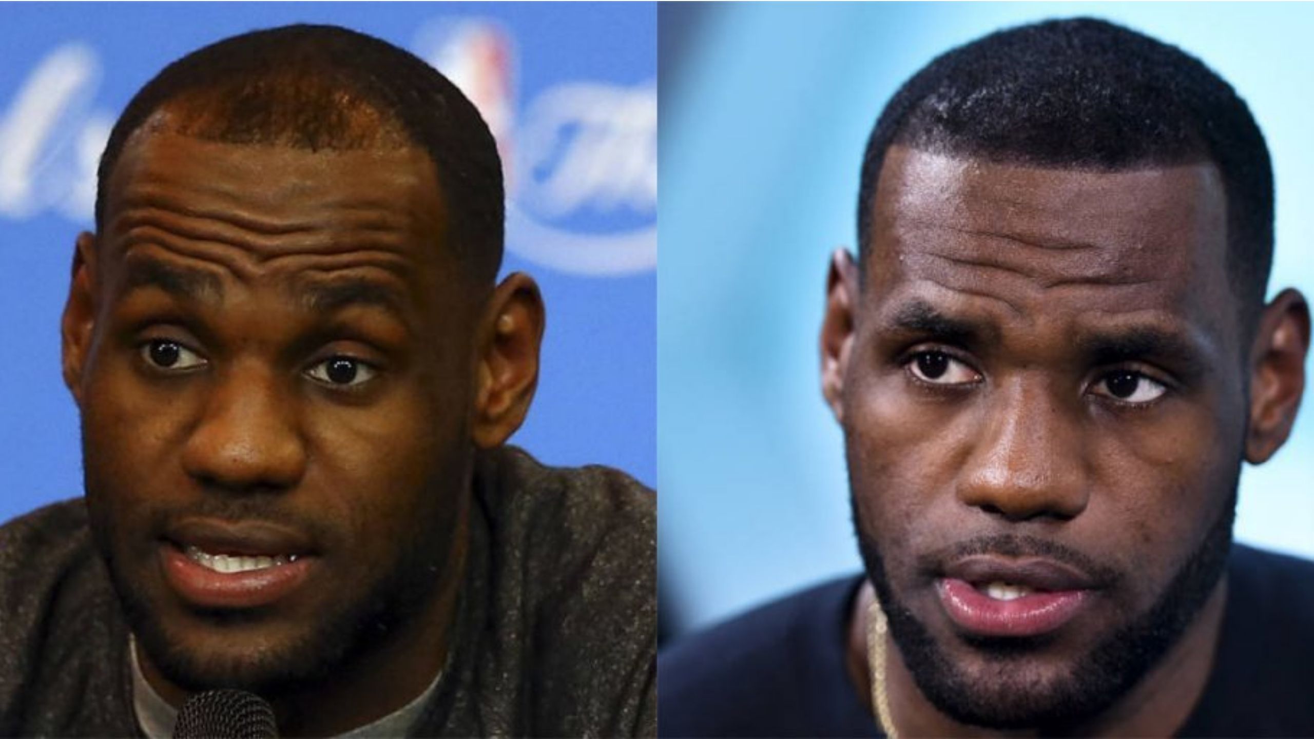 Lebron James Hair Transplant