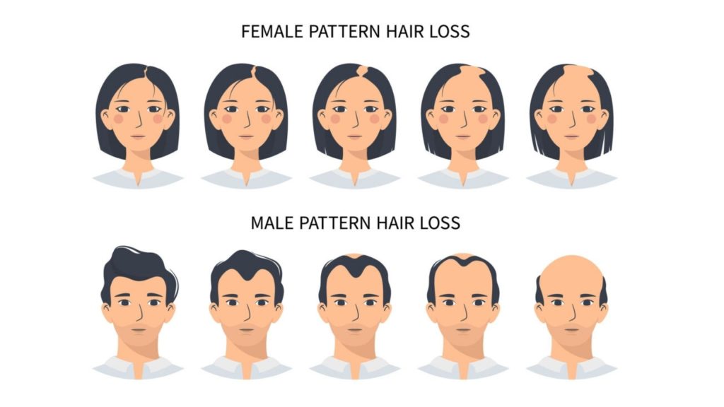 Understanding Different Types of Hair Loss 1