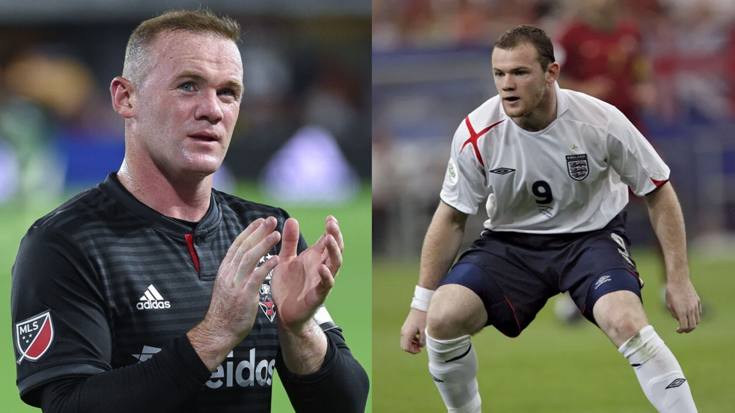 Wayne Rooney Hair Transplant
