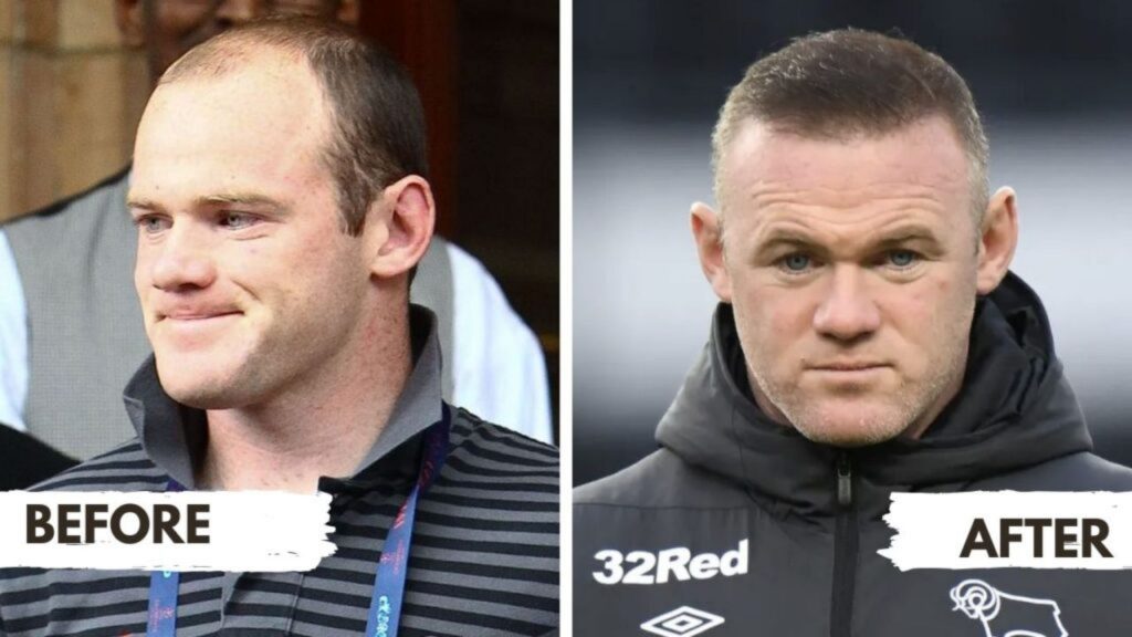 Wayne Rooney Hair Transplant