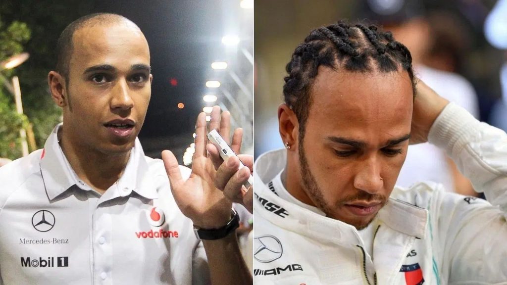 lewis hamilton hair transplant 1