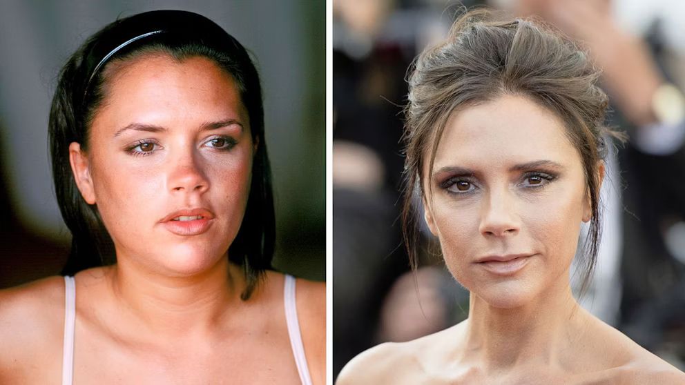 Has Victoria Beckham Had Plastic Surgery? A Closer Look at Her Changing Appearance