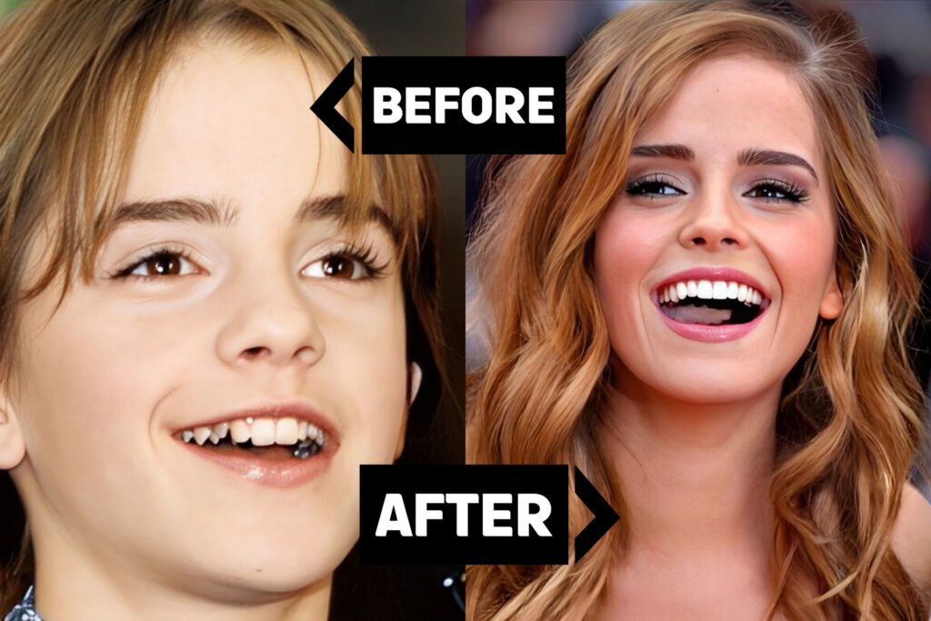 Emma Watson: Natural Beauty or Subtle Cosmetic Enhancements?