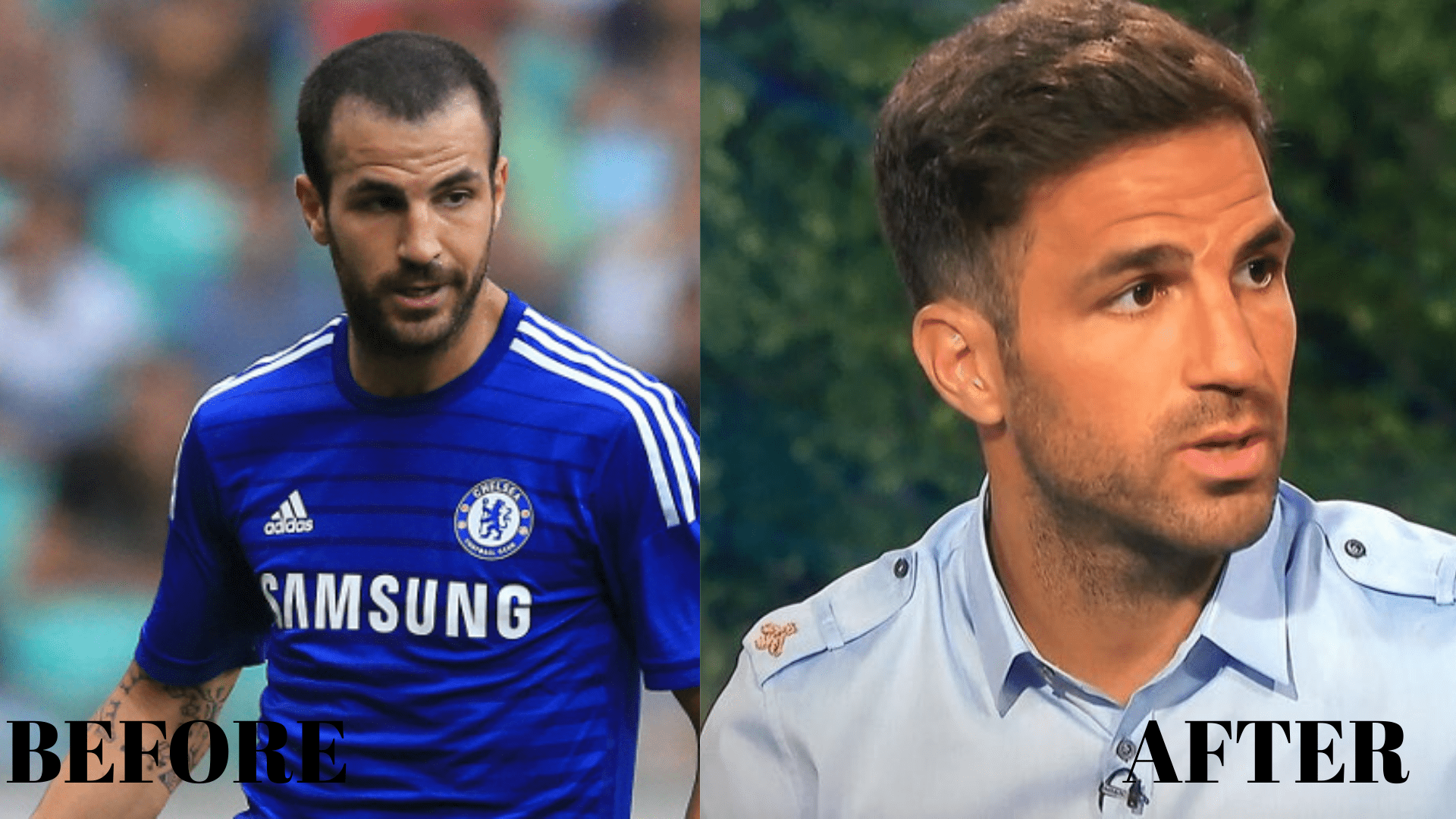 Cesc Fàbregas’ Hair Transplant: The Growing Aesthetic Trends in the Football World