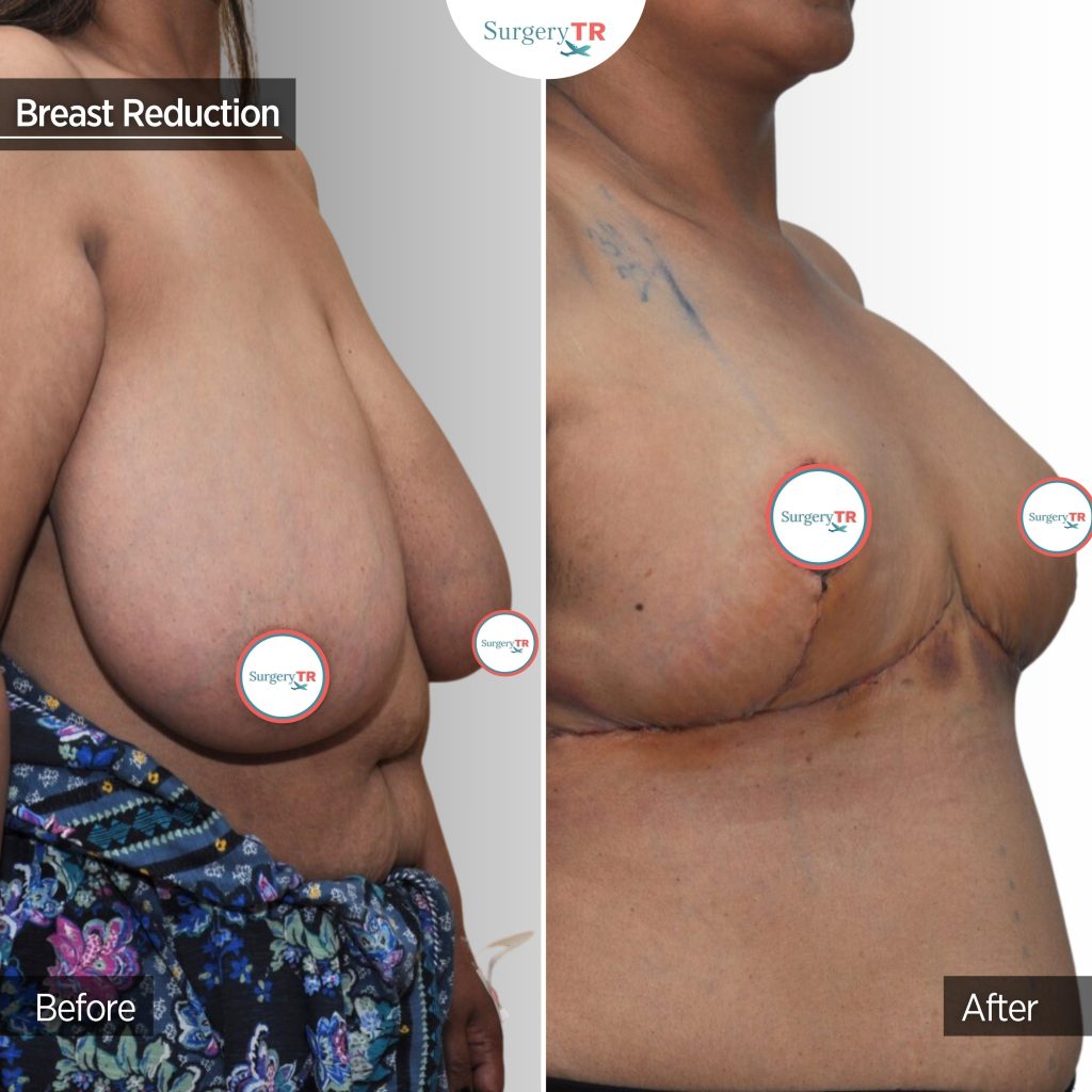 Breast Lift or Breast Reduction Or Both? How to Choose the Right Procedure for You 2 Jas Kakkar