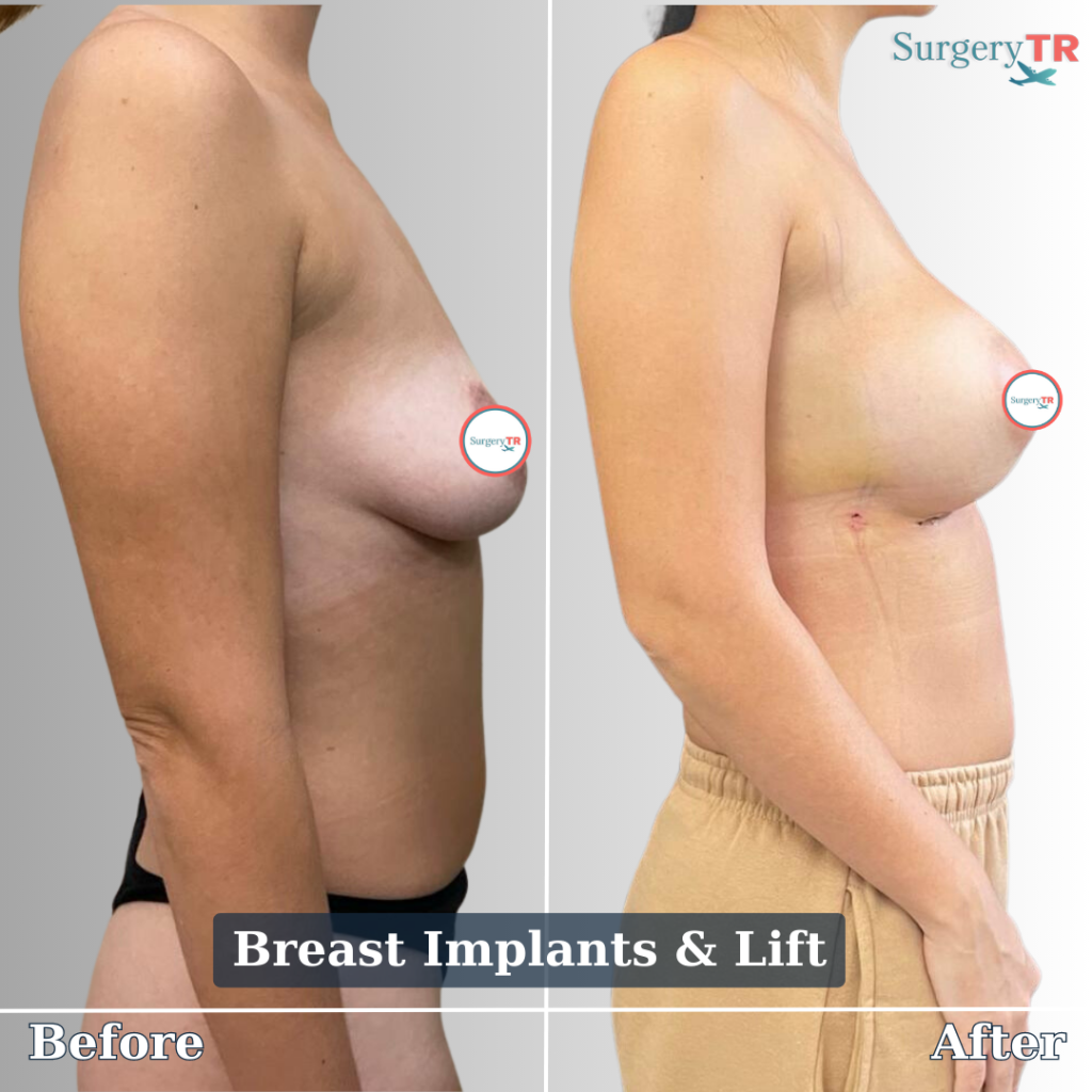 Breast Lift or Breast Reduction Or Both? How to Choose the Right Procedure for You 3 Yeni Tasarim 11 3 1