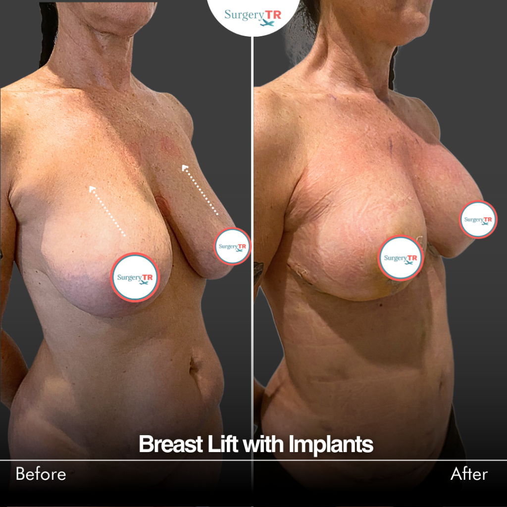 Kylie Jenner’s Disclosure of 445 cc Implants: Is Transparency the New Trend in Aesthetic Surgery? 2 Cristina Soares Breast Lift with Implants 2