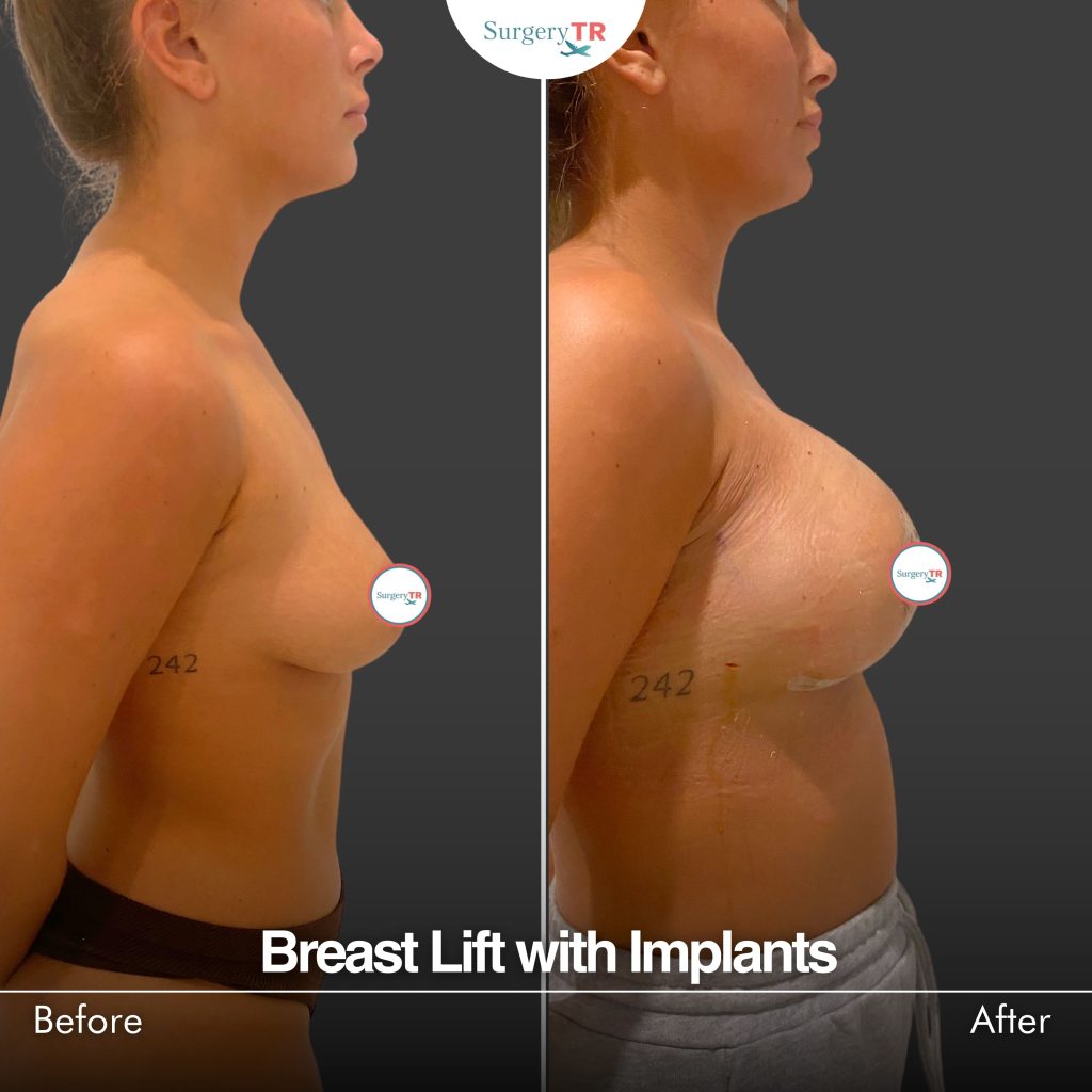 Kylie Jenner’s Disclosure of 445 cc Implants: Is Transparency the New Trend in Aesthetic Surgery? 3 Madison Raffe 1 min