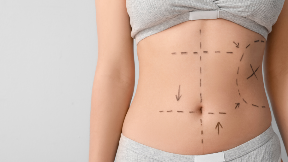 What Is Lipo 360? How It Differs from Traditional Liposuction