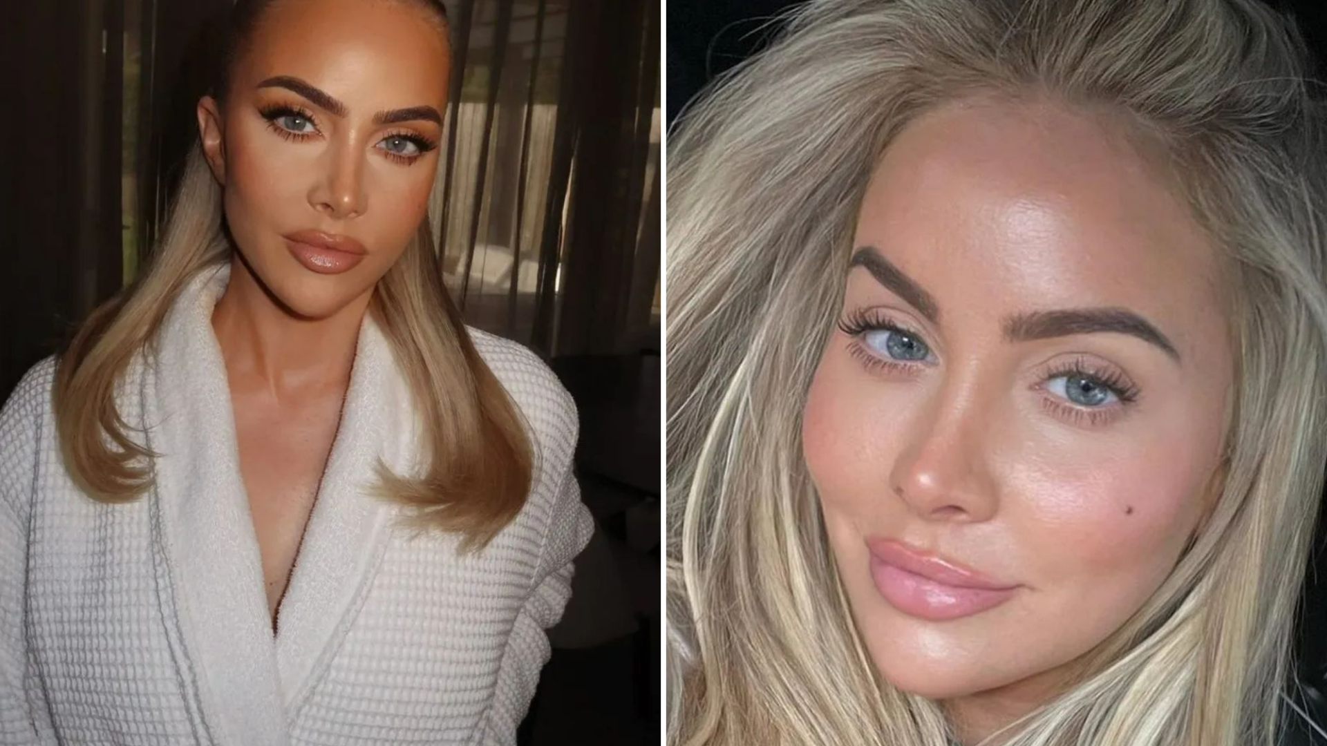 Ashley Stobart’s Facelift Journey: Dissolving 15 Years of Filler and Choosing a More Natural Look – How It Compares to the Turkey Alternative