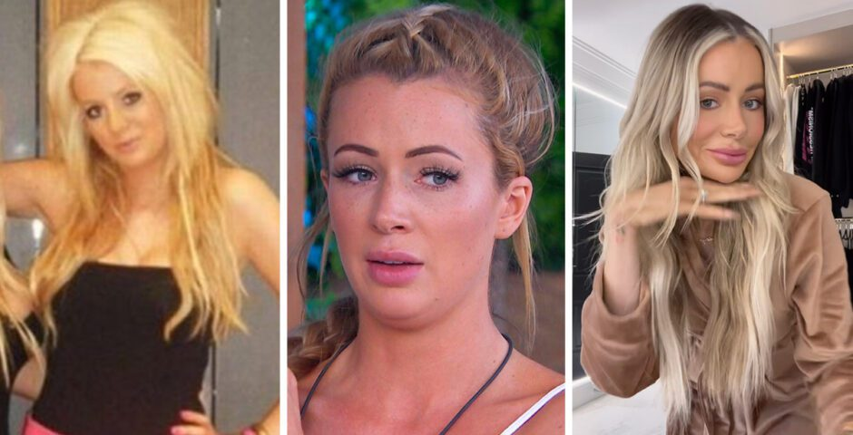 Olivia Attwood and the BBL Rhetoric: Growing Awareness in the UK and Lessons from Turkey’s Demand Surge