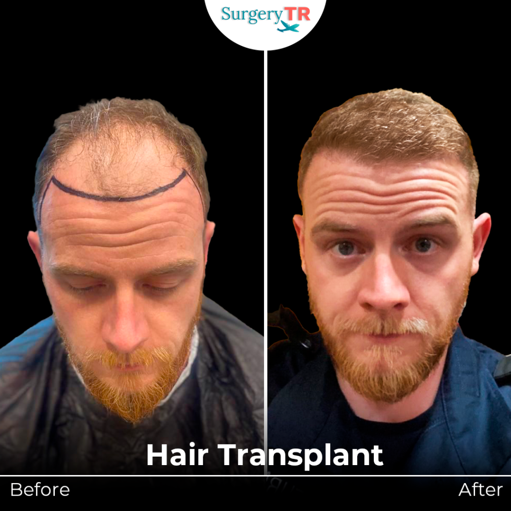 hair transplant 2