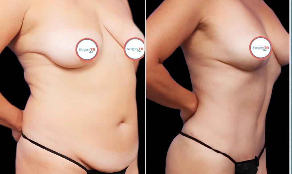 360 Degree Liposuction Before and After Patient Results in Turkey - SurgeryTR