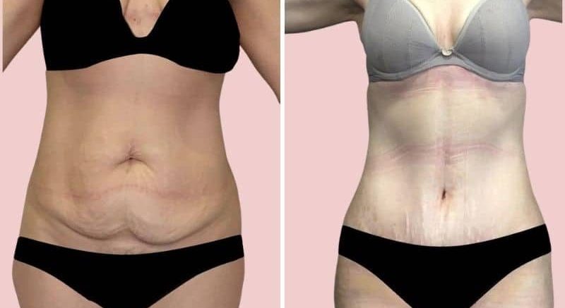 Tummy Tuck Before and After Female Results in Turkey - SurgeryTR Abdominoplasty